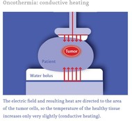 Oncothermia: conductive heating, Medical Center Frankfurt